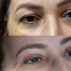 Blefaroplastia 02