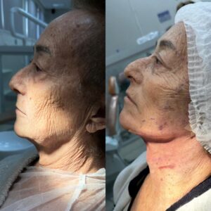 lipo-de-papada-maceio
