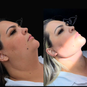 platismoplastia-maceio